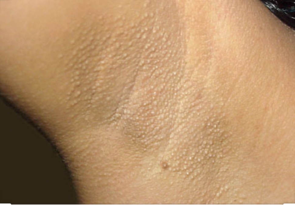 skin tags in armpit
